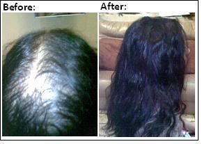 hair photo:hair loss club 